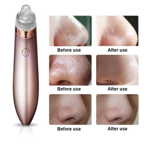 Electric Blackhead Remover - Pore Vacuum Cleaner with Diamond Dermabrasion for Deep Cleansing & Acne Removal - Image 4